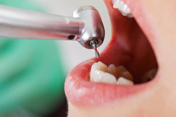 Best Emergency Gum Treatment in Georgetown, SC